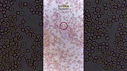 Bir Tüberküloz mikrobunun akyuvar hücreleri tarafından saf dışı bırakılması.