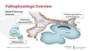 Link Between Serum Uric Acid And Pulmonary Hypertension Confirmed