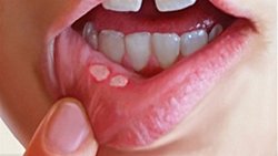 Behçet Hastalığı