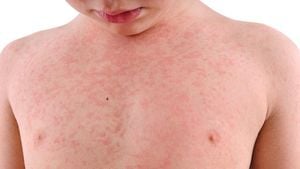 Tokyo Reports Second Measles Case This Year