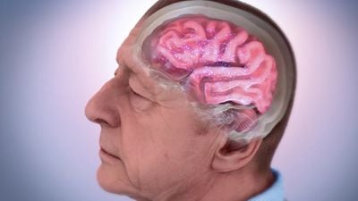 Alzheimer Amiloid-Beta Plaklarını Çözen Nanopartiküller Geliştirildi!