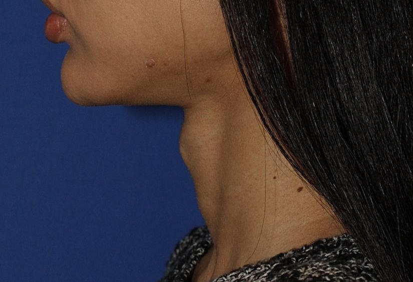 "Adam's Apple" in a woman