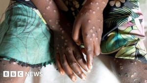 First U.S. Case Of Aggressive Mpox Strain Confirmed