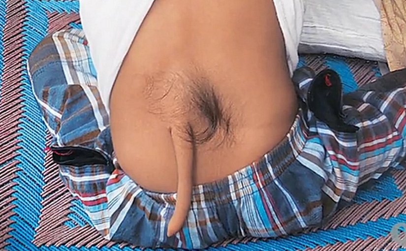 Hindistan'ın Chandigarh bölgesinde doğan Arshid Ali Khan'ın 12 yaşındaki kuyruklu bir fotoğrafı... Tıbbi literatürde bu tür oluşumlara