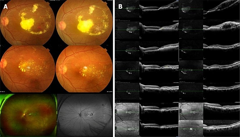 Coats Hastalığına ait görüntüler.