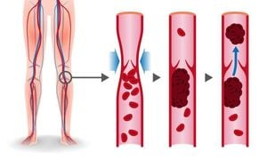 Elevated Basophils Linked To Increased Risk Of LEDVT