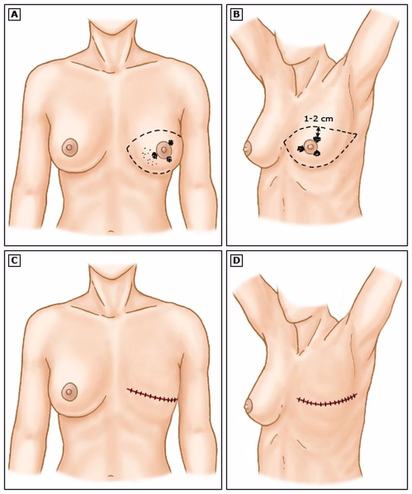 Santral Yerleşimli Meme Kanserinde Modifiye Radikal Mastektomi