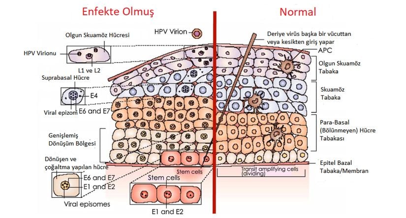 Enfekte olmuş ve normal durumda kütanöz derideki, HPV nedeniyle meydana gelmiş fizyolojik değişiklikler.