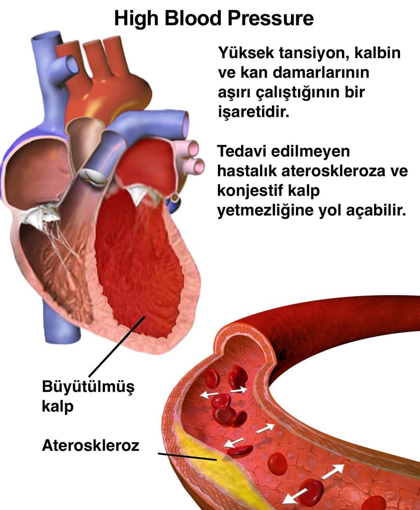 Yüksek tansiyonun etkilerini gösteren çizim