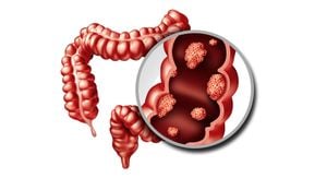 New Study Links Gut Microbiota To Colorectal Polyps