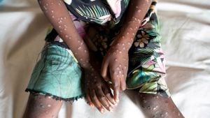 Global Concerns Rise Over Deadly Mpox Strain Spread