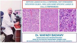 Research Uncovers Unique Immune Signatures In Adrenal Gland DLBCL