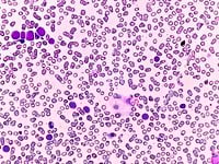 Immunotherapy-Linked ADC Offers Hope for Hard-to-Treat Blood Cancers