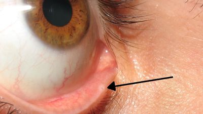 Lacrimal Punctum: Göz Kapaklarınızda Bulunan Ufak Delik Ne İşe Yarar? Ağladığımızda Neden Burnumuz Akar?