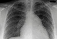 La silicosis resurge con fuerza: se incrementó un 1.423,2% entre 2015 y 2019