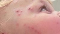 Chickenpox vaccine to be offered on NHS next year, as part of routine MMR jab for babies