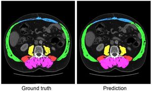 Revolutionary CT-Based Aging Model Predicts Longevity Through AI