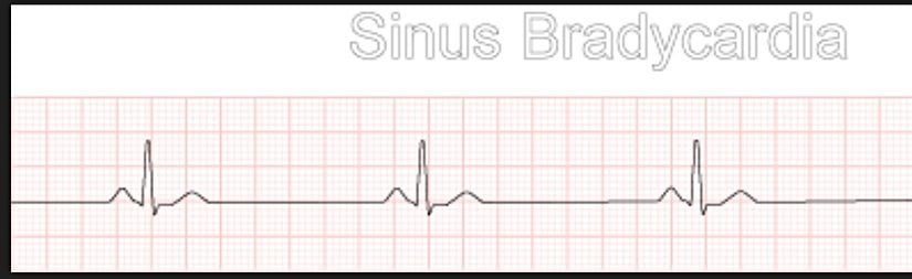 Kalp Yavaş Ritim