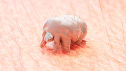 Uyuz Nedir? Uyuz Salgınını Durdurmak Neden Zordur? Uyuz Akarı Nasıl Bulaşır, Nasıl Tedavi Edilir?