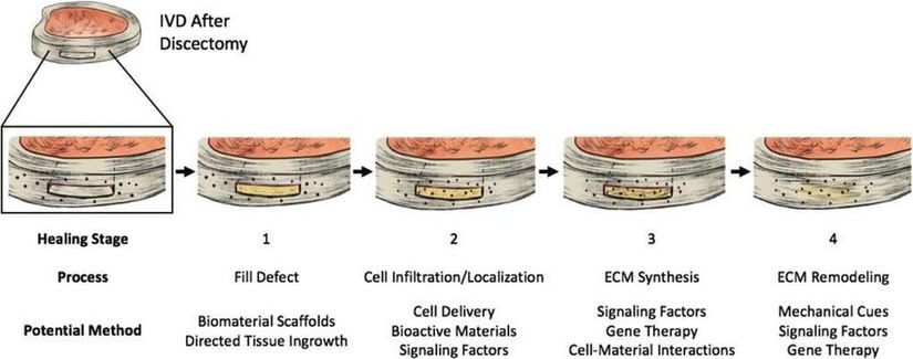 Tam halka şeklindeki onarımın aşamalarına şematik genel bakış. Annulus fibrosus'taki kusurlar, bir diskektomi sırasında cerrahi olarak oluşturulabilir veya intervertebral disk dejenerasyonu yoluyla birikebilir.