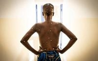 Mpox no longer a global health emergency, WHO says