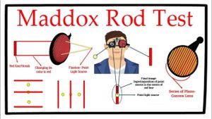 New Study Uses Prism And Maddox Rod Test For AACE Surgery