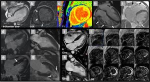 New Imaging Techniques Shed Light On Diastolic Dysfunction