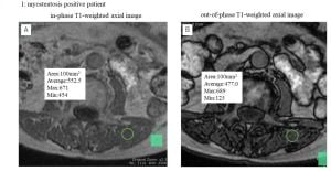 New Study Links Myosteatosis And Chloride Levels To Surgery Outcomes