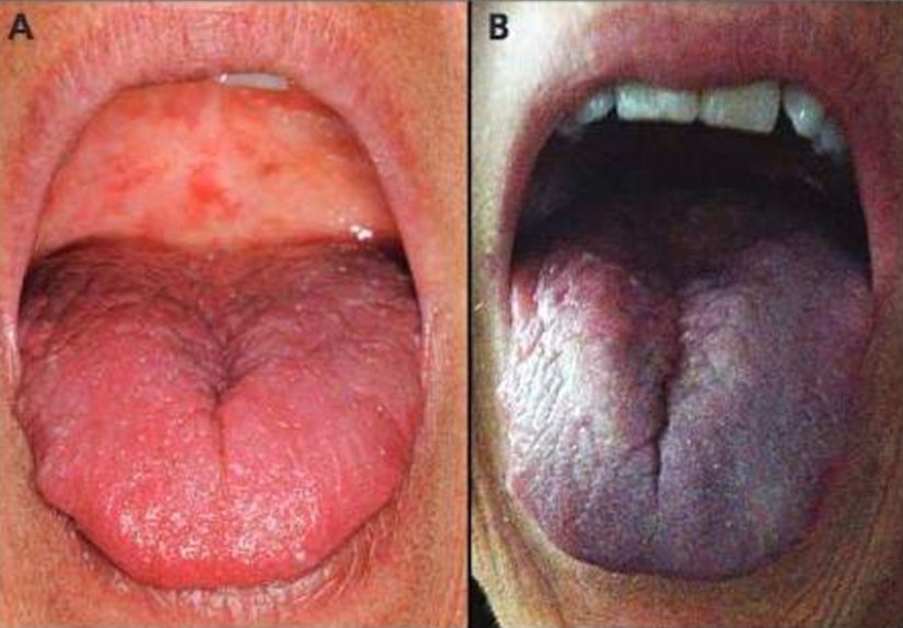 Santral siyanozda dil ve ağız mukozası görünümü.