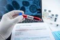 Three more Mpox cases detected in Gauteng