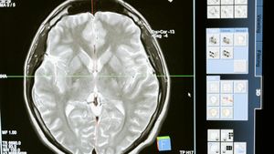 Persian-Galveston Test Validated For TBI Assessment