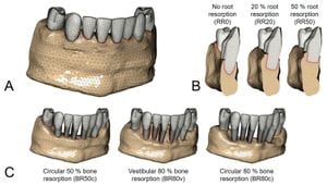 New Insights Into Apical Periodontitis Reveal Key Pathway For Osteoclast Formation