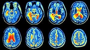 Pozitron Emisyon Tomografisi (PET) Nedir? PET Taraması ile Görüntüleme Nasıl Yapılıyor? Hastalar Nasıl Bir Süreçten Geçiyor?