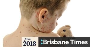 Brisbane Measles Alert: 2-Year-Old Tests Positive