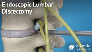 Comparing Surgical Techniques For Dual-Level Lumbar Disc Herniation