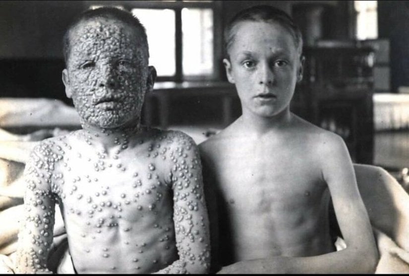 “Variola Major” virusuna yoluxmuş azyaşlı