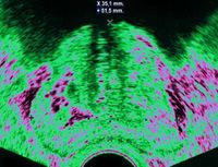 Routine Prostate Cancer Test Rejected for Most Men in UK