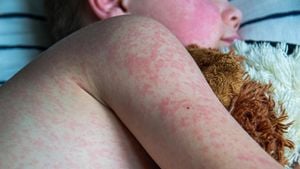 Surge Of Measles Cases Reaches 10.3 Million Worldwide