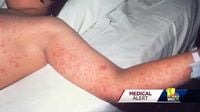 New measles cases confirmed in 2 Prince George's County residents