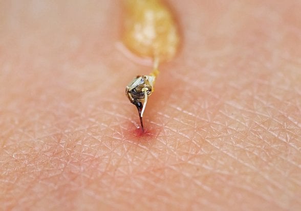 Sokan arının insan derisi üzerindeki iğnesi.