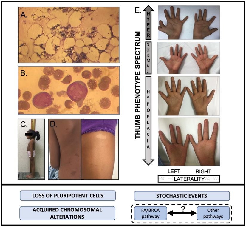 Fanconi Anemia