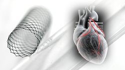 Stent mi Bypass mı? Kalp Hastalıklarında Hangi Tedavi Yöntemi Daha Etkili?