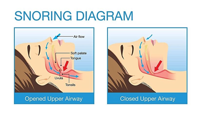 Hava yolu kapalı olduğunda, uvula hava basıncının etkisiyle titreşir ve horlama sesini oluşturur.