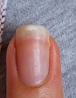 Tırnaklarımızdaki beyaz çizgi veya noktalar neden var?