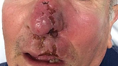 Ekstranodal NK/T Hücreli Lenfoma, Nasal Tip (ENKL) Nedir? Burun ve Yüzün Orta Hattını 