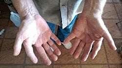 İşlevsel 6 Parmaklılık: Çok Parmaklılık (Polidaktili), Kimi Zaman İşlevsel Olabilir!