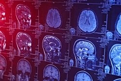 Yeni Yapay Zeka Aracı Beyin Tümörü Sınıflandırmasını Hızlandırıyor!