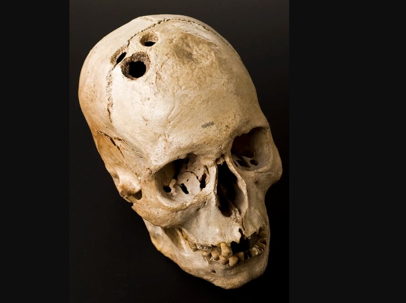 1958 yılında İsrail'in Eriha kentindeki bir mezardan çıkarılan bu kafatası, antik cerrahi yöntem olan trepanasyonla açılmış dört ayrı deliği göstermektedir.