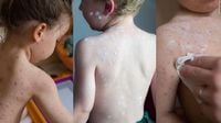NHS to give free Chickenpox vaccine to children