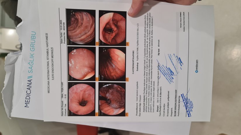12/01/2023 tarihinde endoskopi oldum ve sol en baştaki resimde reflüyü görebilirsiniz ve kenarlardaki kızarıklıklar reflüye sebep olan mide asidinin tahriş ettiği yerler. Bizim şikayetimizin tam noktası orasıdır mide kapakçığının orası.